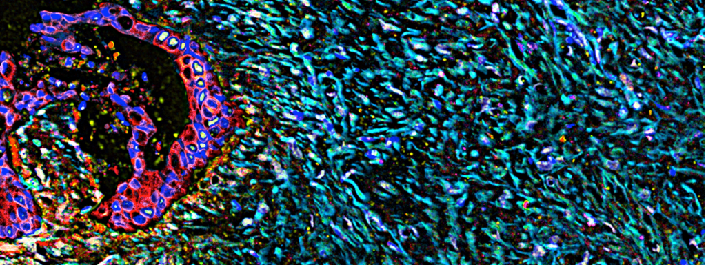 Fluorescence microscopy image of pancreatic tumour cells in their microenvironment. The tumour cells are forming a red mass on the left and to the right are thousands of surrounding healthy cells.