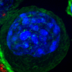 Flouresence microscopy image of a cancer cell surrounded by killer T cells, illustrating how CAR-T therapies work. Image courtesy of the NIH Image library.